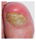 ugly-toenail-fungus.08.16.10.jpg